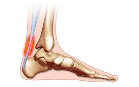 CalfPRO® calf stretcher is a portable and collapsible Calf stretcher that locks your heel in place to deeply stretch your Calf. Plantar fasciitis stretcher. Shin Splints Stretcher. Foot and Ankle mobility stretcher. Helps relieve plantar fasciitis and achilles tendonitis and heel pain. Leveraged Calf Stretcher. CalfPRO is World's deepest Calf Stretch.