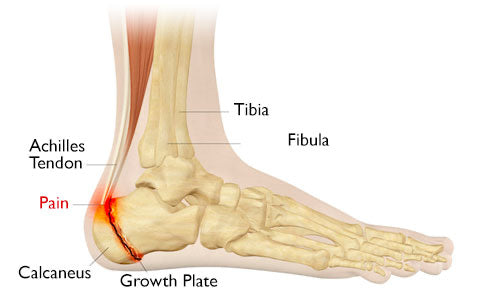 CalfPRO® calf stretcher is a portable and collapsible Calf stretcher that locks your heel in place to deeply stretch your Calf. Plantar fasciitis stretcher. Shin Splints Stretcher. Foot and Ankle mobility stretcher. Helps relieve plantar fasciitis and achilles tendonitis and heel pain. Leveraged Calf Stretcher. CalfPRO is World's deepest Calf Stretch.